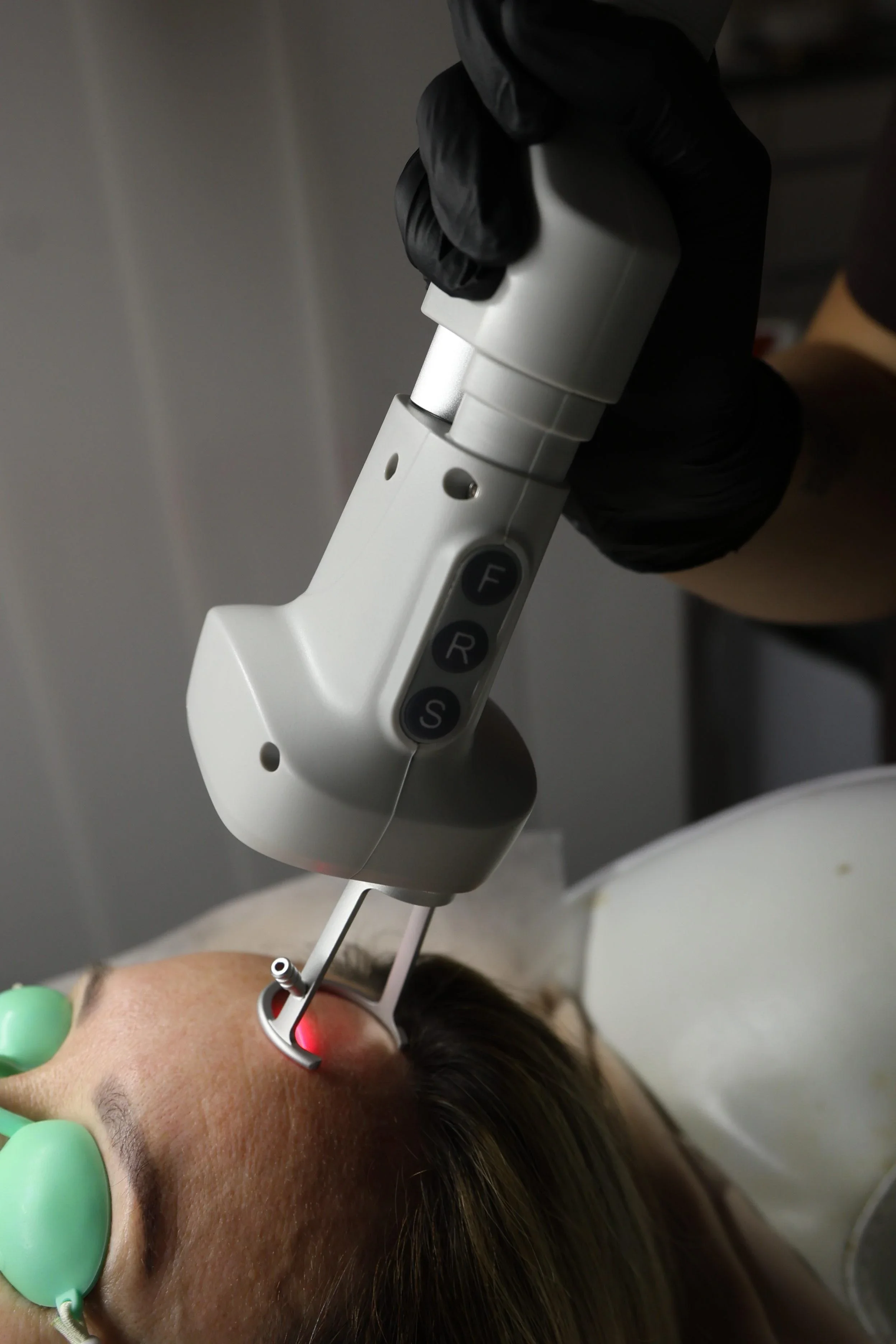 Głowica lasera podczas pracy na skórze, z ochroną oczu pacjentki